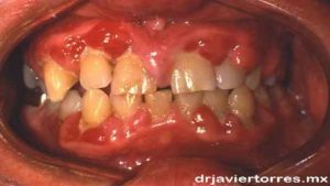 Consecuencias periodontales por presencia de Diabetes Mellitus Tipo II